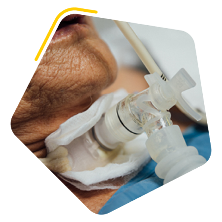 Tracheostomy and respiratory care